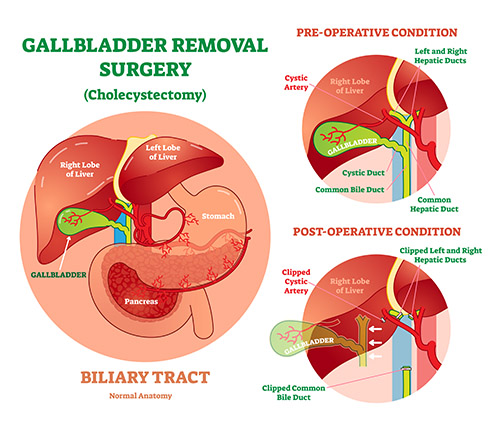 Advantages of Laparoscopic Cholecystectomy (Surgical Gallbladder Removal) Pristyn Care